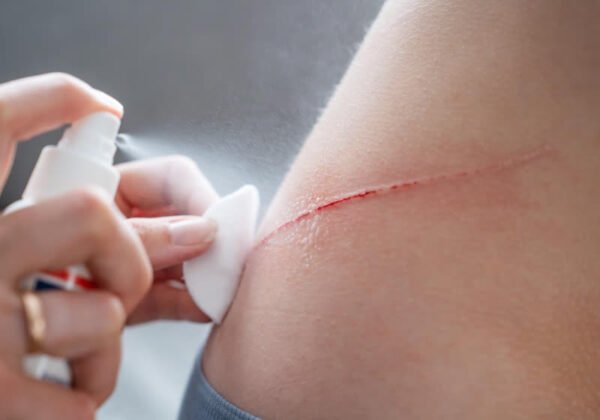 Spray-On AGCL Powder Seals Life-Threatening Wounds in Seconds: A Breakthrough in Hemostatic Techn…