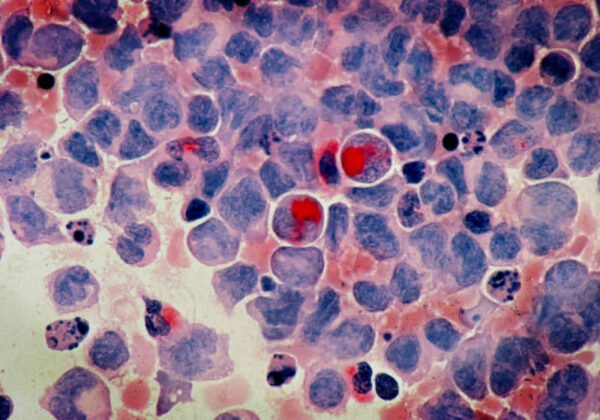 Scientists Develop Iron-Based Nanomaterial That Targets Cancer Cells While Sparing Healthy Tissue